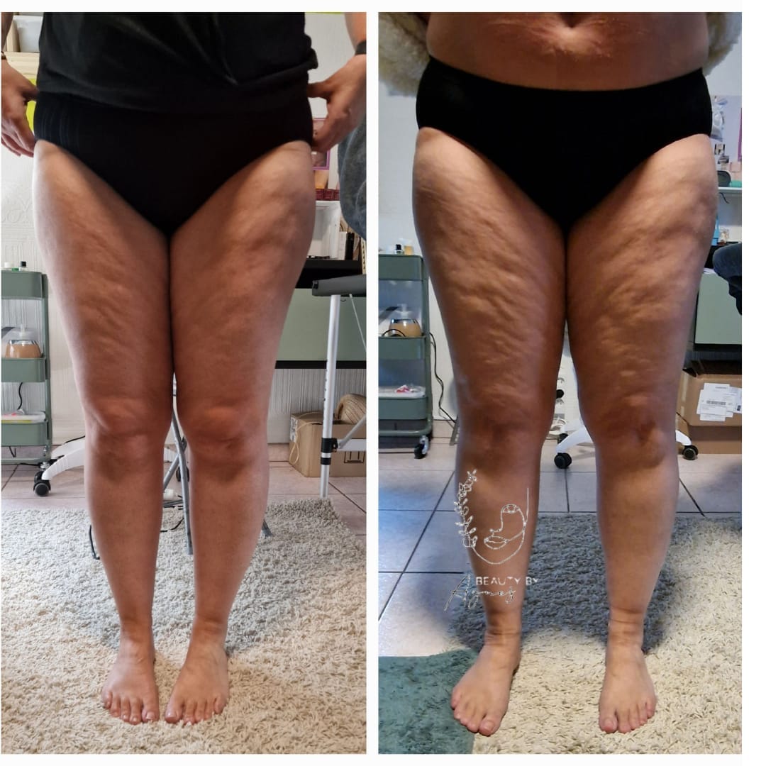 wellnesscupping vacuumbodydrainer