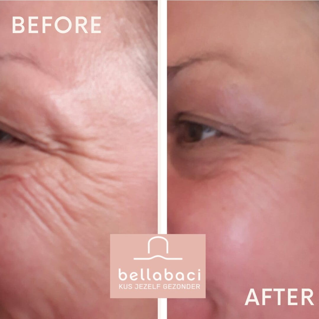 Bellabaci Cupping Resultaten