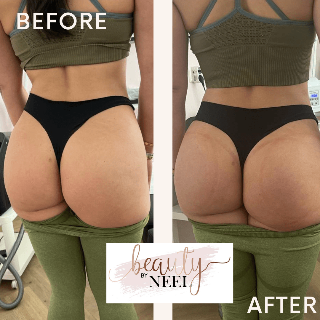 wellnesscupping vacuumbodydrainer