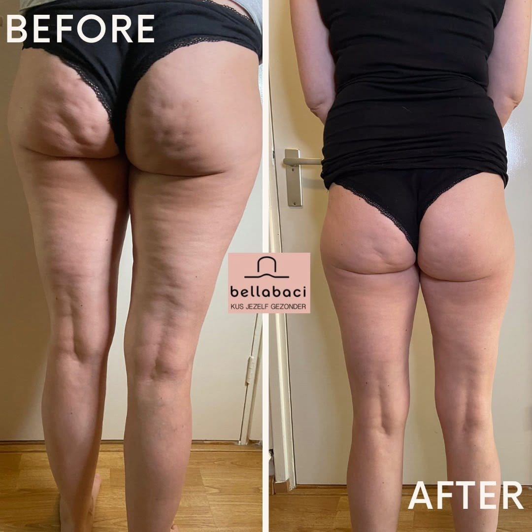 Bellabaci Cupping Resultaten Bellabaci Cupping Resultaten
