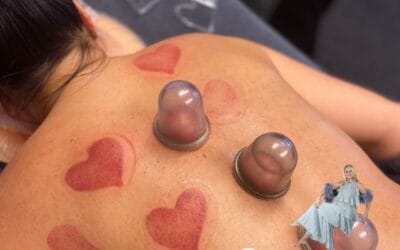 Blauwe plekken bij cupping, is dat oké?