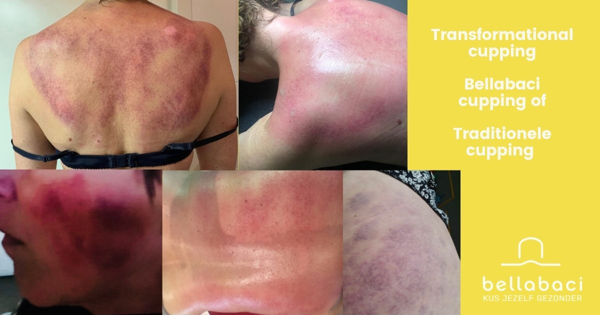 Transformational cupping